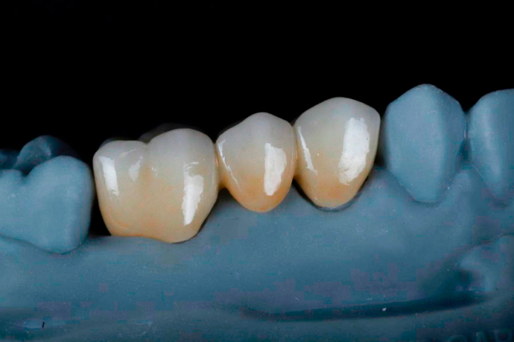 Modelo odontológico impresso em 3D com ponte fixa e coroas provisórias de alta precisão, mostrando adaptação perfeita sobre a arcada.