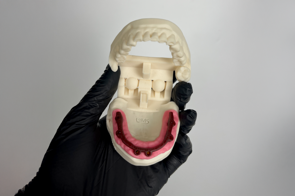 Modelo odontológico impresso em 3D com prótese sobre implante, exibindo barra de protocolo e gengiva artificial, segurado por luva preta.