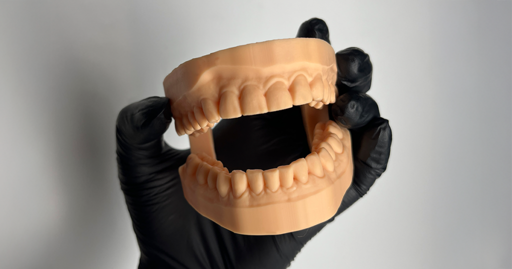 Modelo de trabalho odontológico impresso em 3D, segurado por luva preta, mostrando arcada dentária superior e inferior para planejamento clínico.